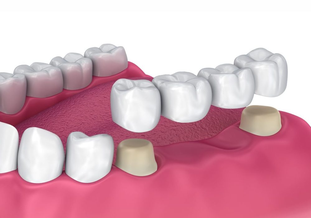 dental-bridges-1200x800